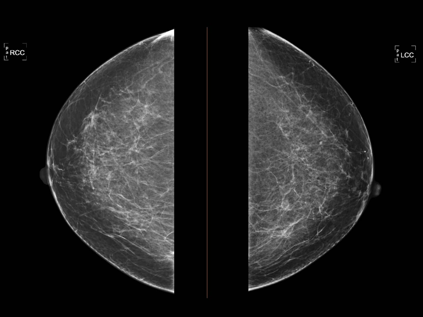 a-woman’s-breast-cancer-was-missed-on-multiple-mammograms-she-had-higher-breast-density,-which-can-hide-tumors.